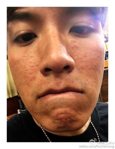 曝柯震东满脸冒痘惊人照片,柯震东吸毒被抓具