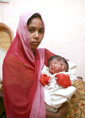 震惊女子生下罕见双面女婴,全国首例双头女婴真实照片