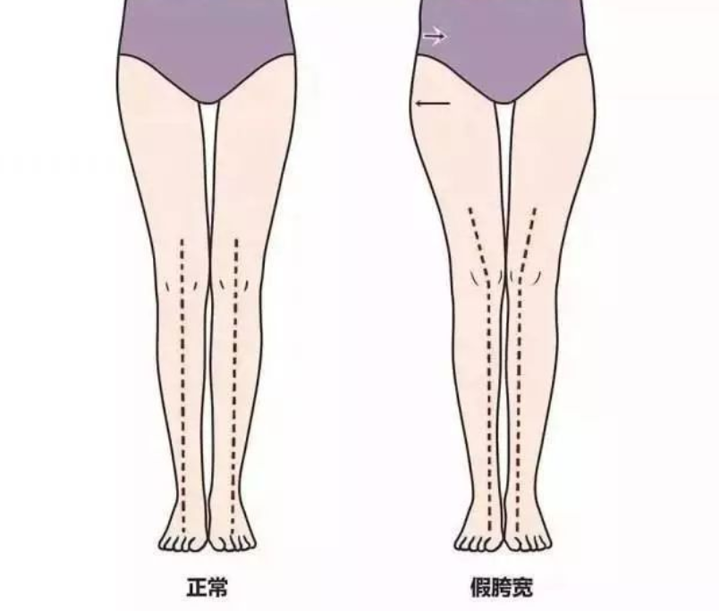 女生夹腿综合症怎么办?有什么影响?女生有这种行为是什么意思?