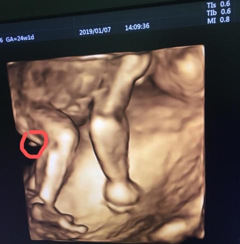 怀孕几个月能看出男孩女孩准确 胎儿性别成形的时间?